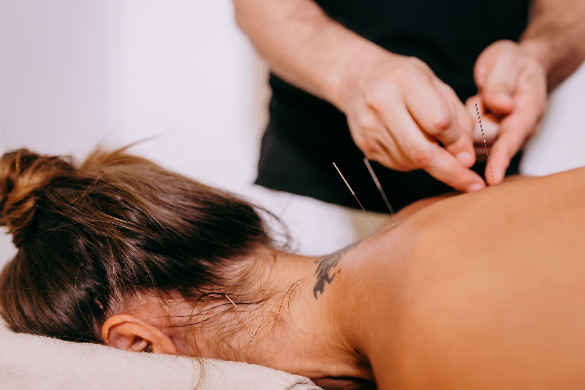 A practitioner placing fine needles in a patient's upper back