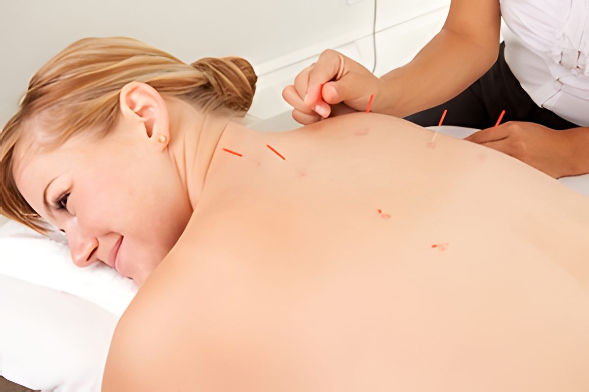 Fine needles placed in a patient's back