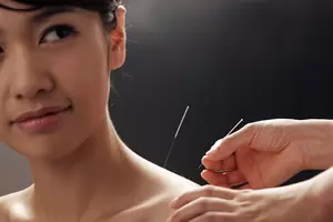 Dry needling techniques